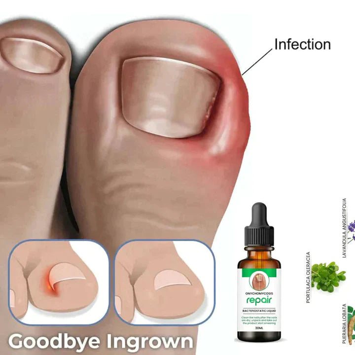 Professional Nail Repair Serum - 100% Natural, Anti-Infective, Fungal Infection Removal, 30ML
